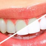 Teeth whitening pencil reviews bliq