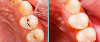 Caries - before and after treatment