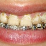 Caries from braces