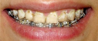 Caries from braces