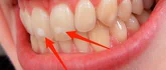 Caries in the white spot stage