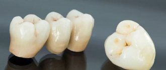 Ceramic dental bridge