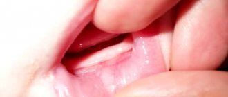 Киста прорезывания зубов