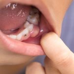 Teething cyst in children