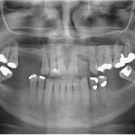 impacted wisdom tooth cyst