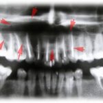 Кисты зубочелюстной области. Обширные костные дефекты.