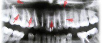 Кисты зубочелюстной области. Обширные костные дефекты.