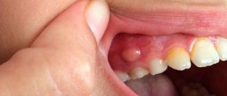 Classification of abscess in dentistry - Dentistry Line of Smiles