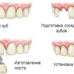 Классификация дефектов зубных рядов по Кеннеди. Ортопедия
