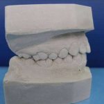 Classification of gypsum and its use in orthopedic dentistry