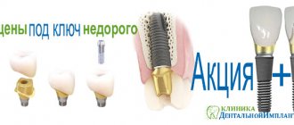 Dental implantation clinic in Moscow, promotional prices on dental-implantology.ru