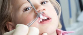 When is tooth extraction necessary?