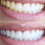 When is it recommended to use Crest Whitestrips?