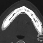 Компьютерная томография челюсти, пораженной фосфорным некрозом