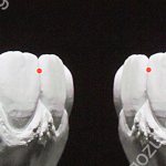 контактное место между зубами
