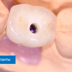 crown on a tooth on an implant