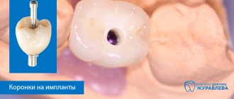 коронка на зуб на импланте
