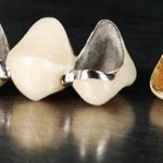Crown on a tooth