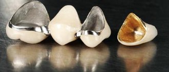 Crown on a tooth