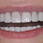 Crowns on front teeth