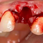 кровотечение после удаления зуба