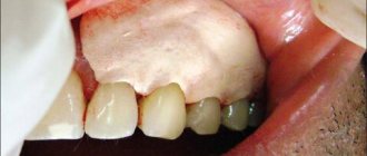 Therapeutic periodontal bandage