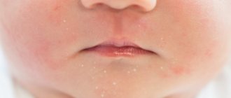 Treatment of acne in children