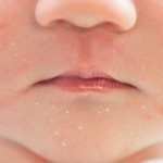 Treatment of acne in children