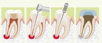Treatment of dental granuloma
