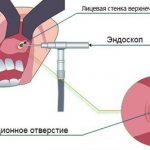 Treatment of maxillary sinus cyst