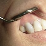 treatment of dental cyst without surgery