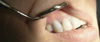 treatment of dental cyst without surgery