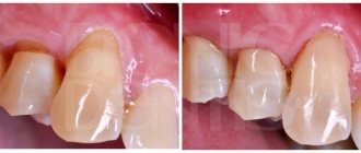 treatment of wedge-shaped defect