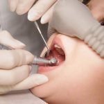 Treatment of baby teeth under sedation