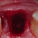 Treatment of stomatitis after tooth extraction