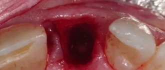 Treatment of stomatitis after tooth extraction