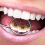 Lingual braces are the most expensive option for correcting malocclusion in adults.