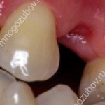 The socket after tooth extraction is normal