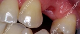 The socket after tooth extraction is normal