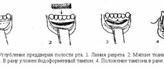 Small vestibule of the oral cavity in children