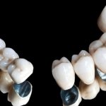 Metal-ceramic crowns on teeth