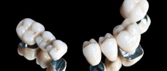 Металлокерамические коронки на зубы