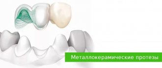 Metal-ceramic dentures