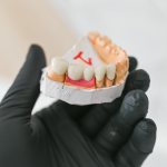 Bridge on chewing teeth made of metal-ceramics for the patient
