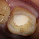 может ли быть аллергия на пломбу в зубе