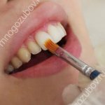 Можно ли отбелить керамические зубы