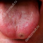The photo shows ulcerative glossitis