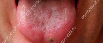 The photo shows ulcerative glossitis