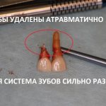 На фотографии отчетливо видно, что на обоих резцах имеется поражение: корневая часть зубов была разрушена, изъедена, и эти зубы невозможно было сохранить. Хирург Магомед Дахкильгов
