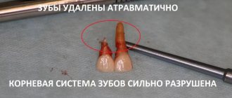 The photograph clearly shows that both incisors have damage: the root part of the teeth was destroyed, eaten away, and these teeth could not be saved. Surgeon Magomed Dakhkilgov 